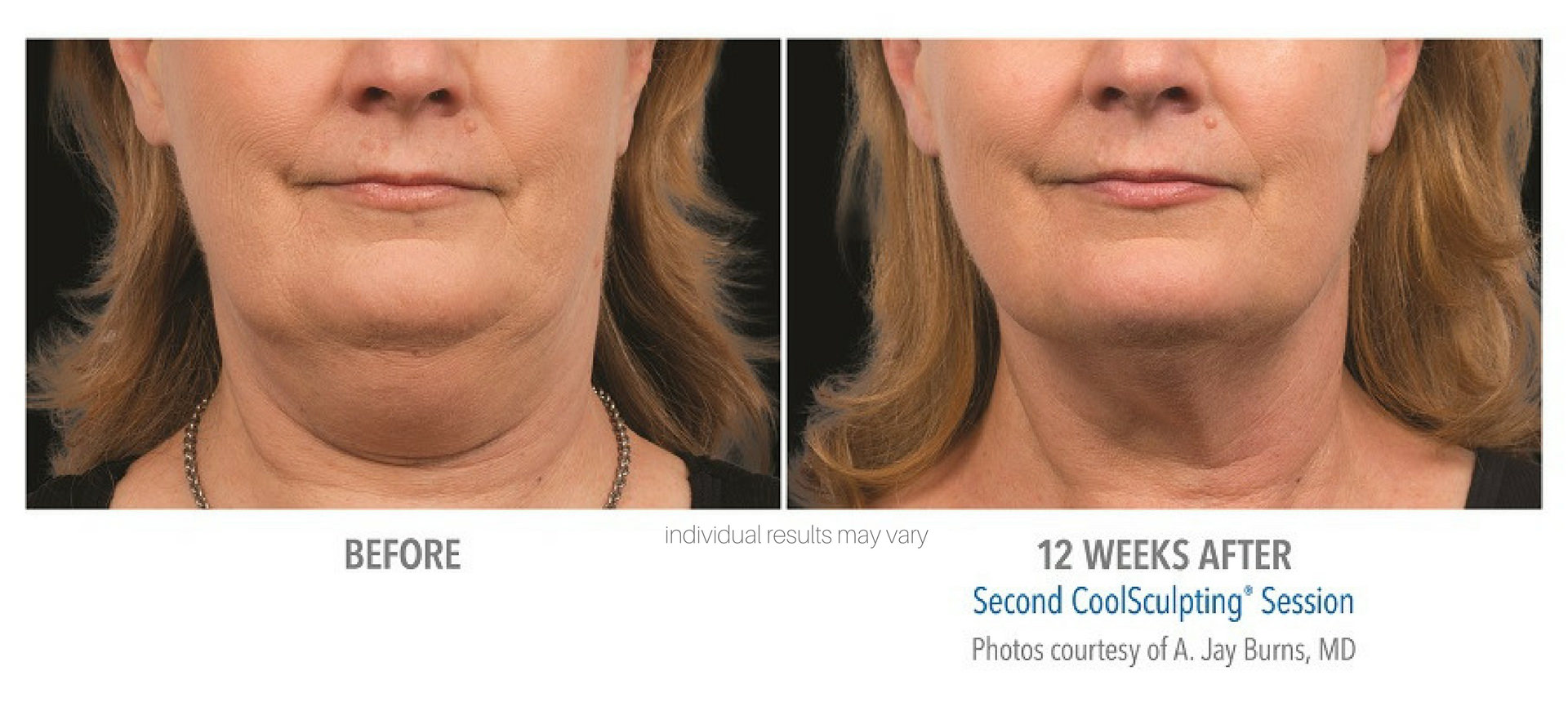 Coolsculpting Before And After 2