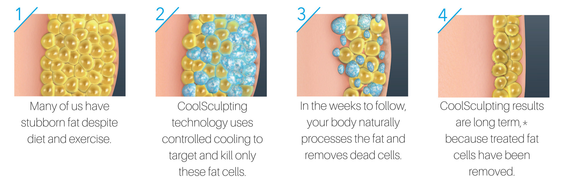 How Coolsculpting Works Web